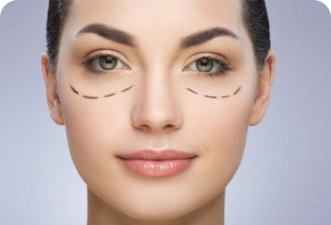 Blefaroplastia