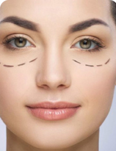 Blefaroplastia